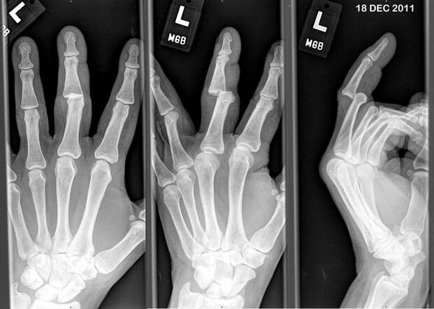 Radiographie des doigts disloqués