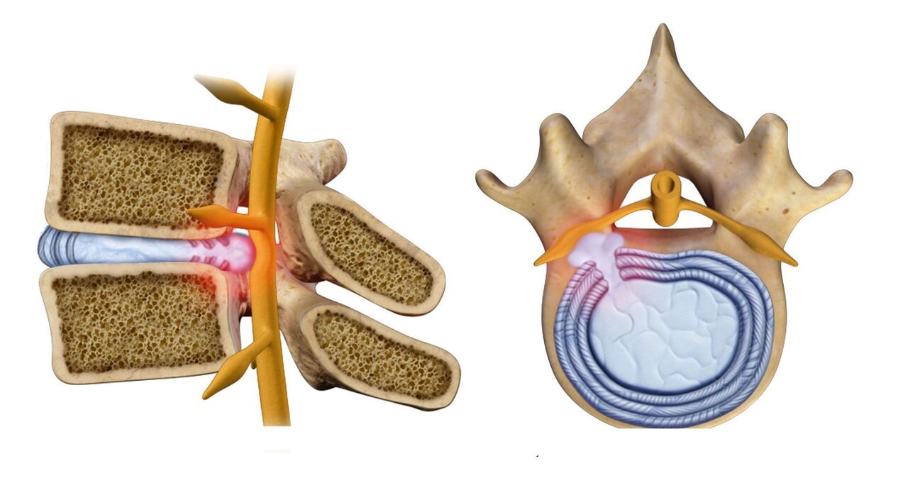 hernie vertébrale dans l'ostéochondrose thoracique