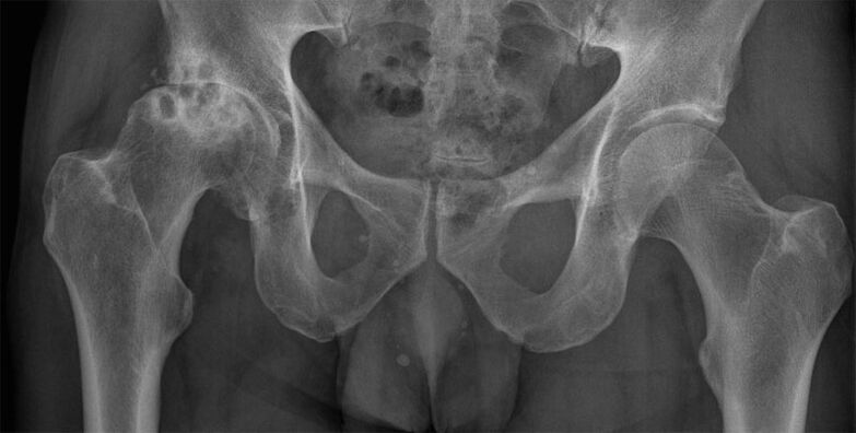 Arthrose déformante de l'articulation de la hanche aux rayons X