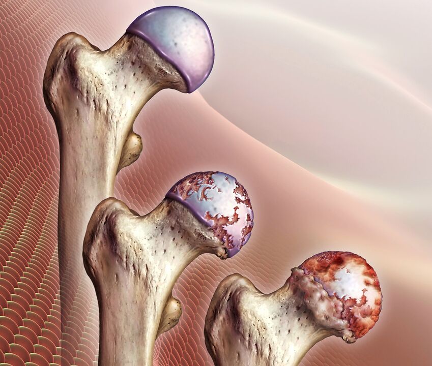 Le développement de l'arthrose de l'articulation de la hanche