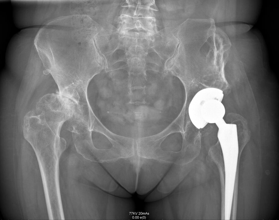 Radiographie de l'articulation de la hanche après arthroplastie
