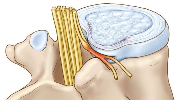 L'ostéochondrose lombaire peut entraîner des complications sous forme de hernie intervertébrale