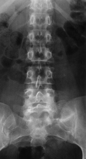 Pour diagnostiquer l'ostéochondrose lombaire, une radiographie est réalisée