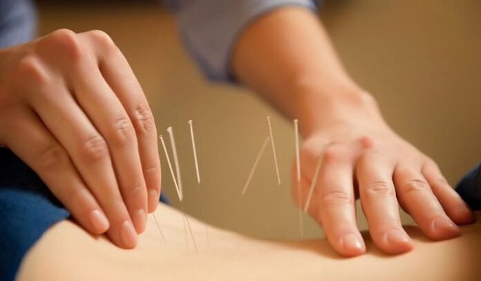 l'acupuncture pour traiter les douleurs lombaires