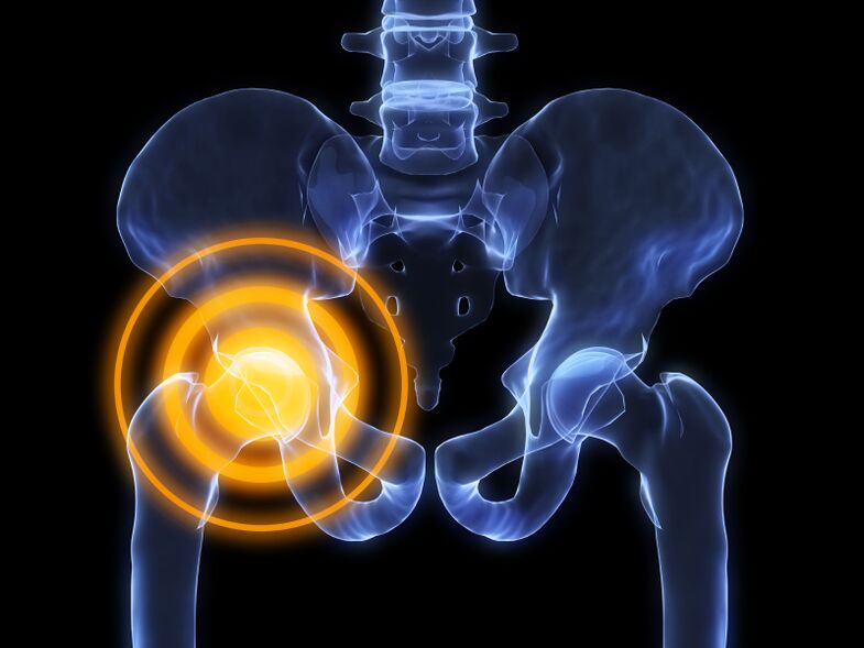 arthrose de l'articulation de la hanche